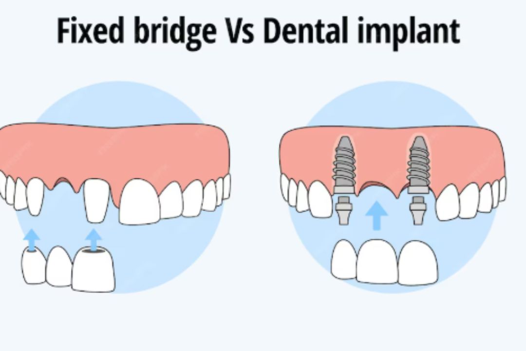 Fixed bridge vs dental implant comparison showing tooth replacement options for missing teeth